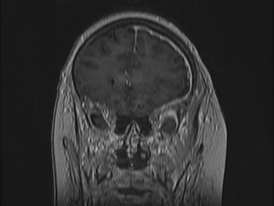 File:Atypical meningioma (Radiopaedia 62985-71406 Coronal T1 C+ 30).jpg