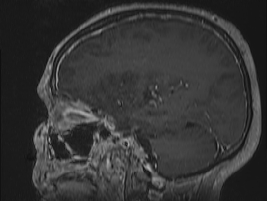 Atypical meningioma (Radiopaedia 62985-71406 Sagittal T1 C+ 59).jpg
