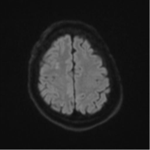 File:Atypical meningioma (WHO Grade II) (Radiopaedia 54742-60981 Axial DWI 50).png