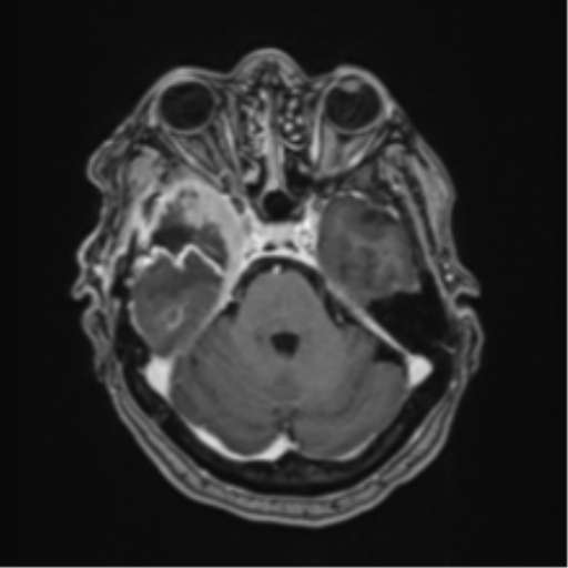 Atypical meningioma (WHO Grade II) (Radiopaedia 54742-60981 Axial T1 C+ 20).png