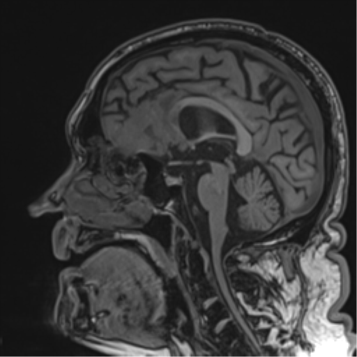 Atypical meningioma (WHO grade II) with brain invasion (Radiopaedia 57767-64729 Sagittal T1 35).png