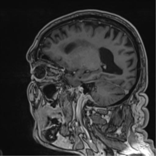 Atypical meningioma (WHO grade II) with brain invasion (Radiopaedia 57767-64729 Sagittal T1 C+ 27).png