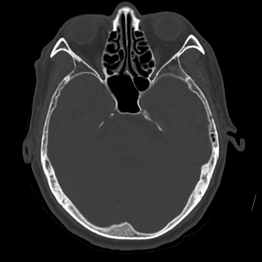 Atypical meningioma (WHO grade II) with osseous invasion (Radiopaedia 53654-59715 Axial bone window 27).png