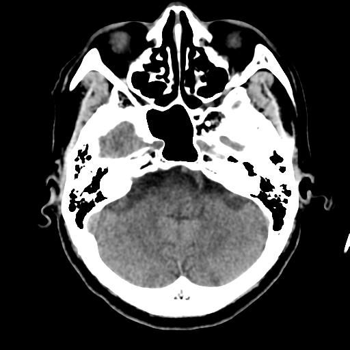 Atypical meningioma (WHO grade II) with osseous invasion (Radiopaedia 53654-59715 Axial non-contrast 14).png