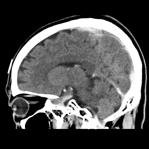 Atypical meningioma (WHO grade II) with osseous invasion (Radiopaedia 53654-59715 G 32).png