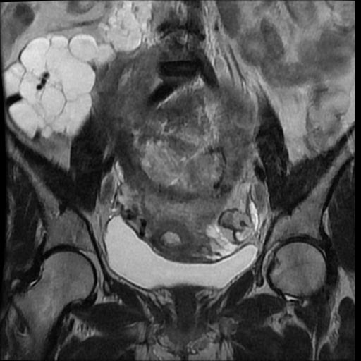File:Atypical retroperitoneal lymphocoeles with large leiomyoma of uterus (Radiopaedia 32084-33027 Coronal T2 19).jpg
