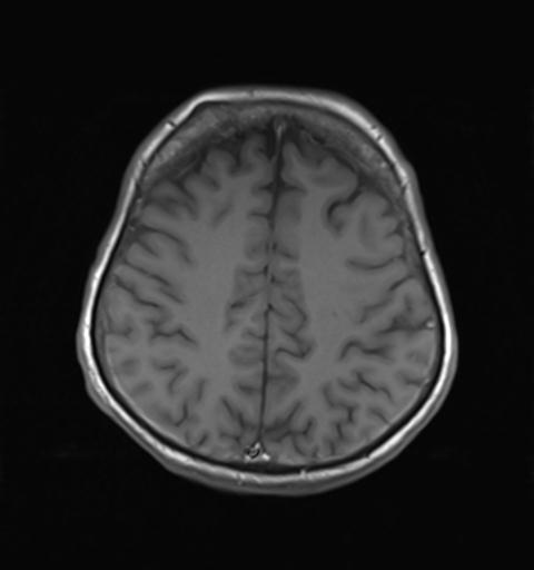 File:Autoimmune limbic encephalitis (Radiopaedia 30363-31005 Axial T1 24).jpg