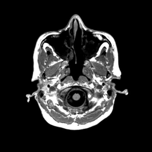 Autoimmune limbic encephalitis (Radiopaedia 30363-31005 T1 Axial 1mm 19).jpg