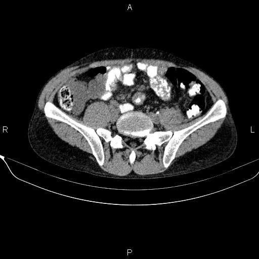 Autoimmune pancreatitis (Radiopaedia 84925-100431 Axial non-contrast 39).jpg