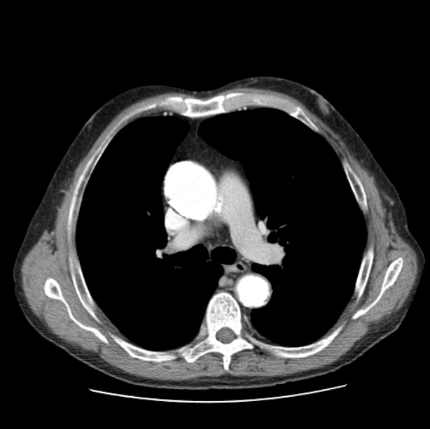 Autosomal dominant polycystic kidney disease (Radiopaedia 27851-28094 B 25).jpg
