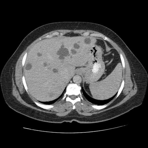 Autosomal dominant polycystic kidney disease with hepatic involvement (Radiopaedia 32693-33662 C 12).jpg