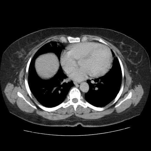 File:Autosomal dominant polycystic kidney disease with hepatic involvement (Radiopaedia 32693-33662 C 2).jpg