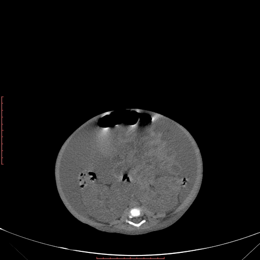 Autosomal recessive polycystic kidney disease associated with Caroli disease (Radiopaedia 61932-69984 Axial non-contrast 242).jpg