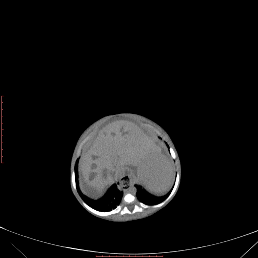 Autosomal recessive polycystic kidney disease associated with Caroli disease (Radiopaedia 61932-69984 B 106).jpg