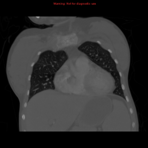 File:Avascular necrosis in sickle cell disease (Radiopaedia 17448-17152 Coronal bone window 37).jpg