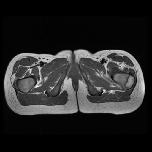 File:Avascular necrosis of the hip (Radiopaedia 29563-30067 Axial T1 16).jpg