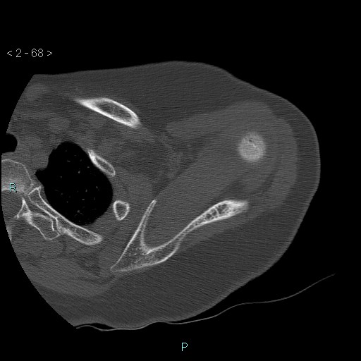 Avascular necrosis of the shoulder - Cruess stage I (Radiopaedia 77674-89887 Axial bone window 17).jpg