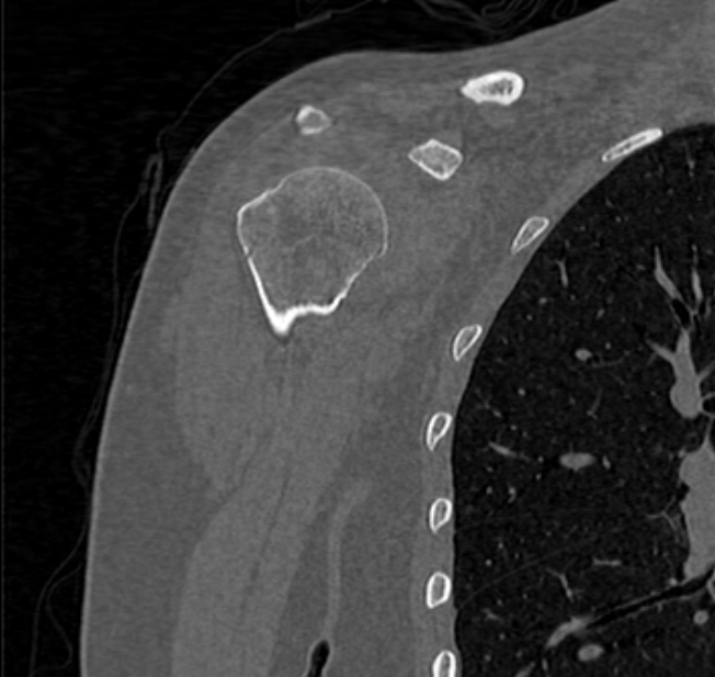 Avulsion fracture - greater tuberosity of humerus (Radiopaedia 71216-81514 Coronal bone window 16).jpg