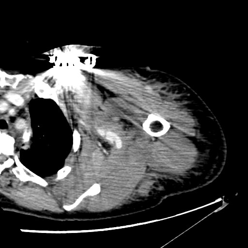 File:Axillary arterial pseudoaneurysm (Radiopaedia 24925-25195 A 11).jpg