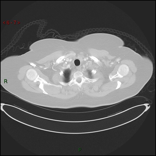 Azygos fissure and lobe (Radiopaedia 47620-52278 Axial lung window 7).jpg