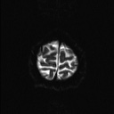 Balo concentric sclerosis (Radiopaedia 50458-55940 Axial DWI 2).jpg