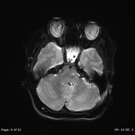Balo concentric sclerosis (Radiopaedia 61637-69636 Axial DWI 6).jpg