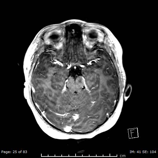 Balo concentric sclerosis (Radiopaedia 61637-69636 Axial T1 C+ 25).jpg