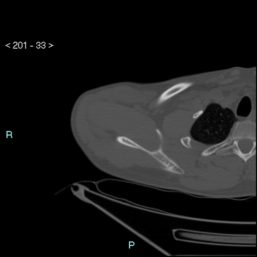Bankart lesion with glenoid bone defect - assessment TC with PICO method (Radiopaedia 42855-93901 Axial bone window 32).jpg