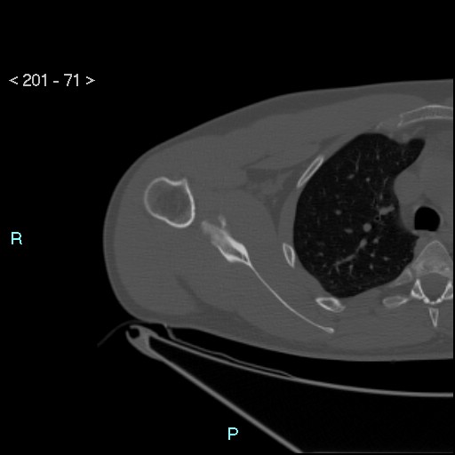File:Bankart lesion with glenoid bone defect - assessment TC with PICO method (Radiopaedia 42855-93901 Axial bone window 70).jpg