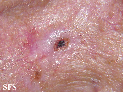 Basal Cell Carcinoma (Dermatology Atlas 112).jpg