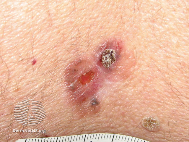 File:Basal cell carcinoma affecting the trunk (DermNet NZ lesions-bcc-trunk-0678).jpg