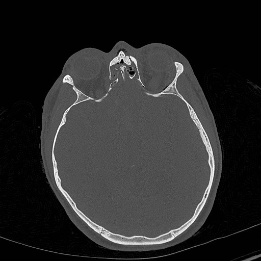 Base of skull fracture with bilateral Le Fort fractures (Radiopaedia 47094-51638 Axial bone window 45).jpg