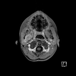 Base of skull rhabdomyosarcoma (Radiopaedia 32196-33142 T1 C+ fat sat 18).jpg