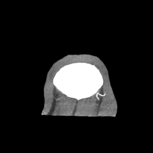 Basilar and bilateral vertebral artery occlusion (Radiopaedia 45592-49723 B 100).png