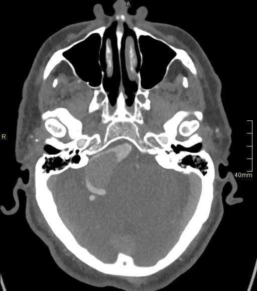 Basilar artery aneurysm (Radiopaedia 56261-62932 A 51).jpg