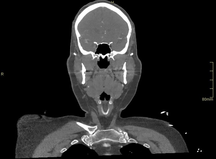 Basilar artery aneurysm (Radiopaedia 56261-62932 B 2).jpg