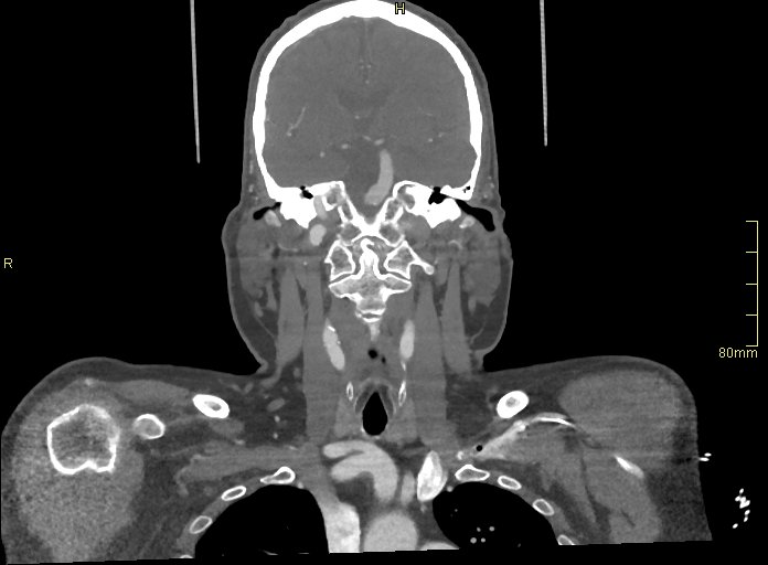 Basilar artery aneurysm (Radiopaedia 56261-62932 B 23).jpg