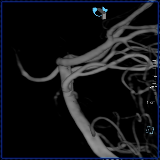 Basilar artery perforator aneurysm (Radiopaedia 82455-99524 3D Left VA 20).jpg