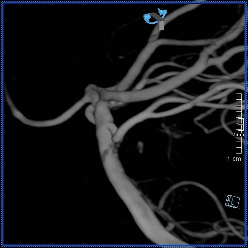 Basilar artery perforator aneurysm (Radiopaedia 82455-99524 3D Left VA 25).jpg