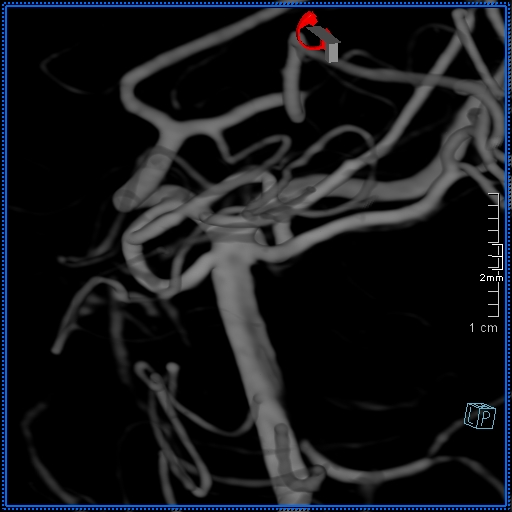 Basilar artery perforator aneurysm (Radiopaedia 82455-99524 3D Left VA 8).jpg