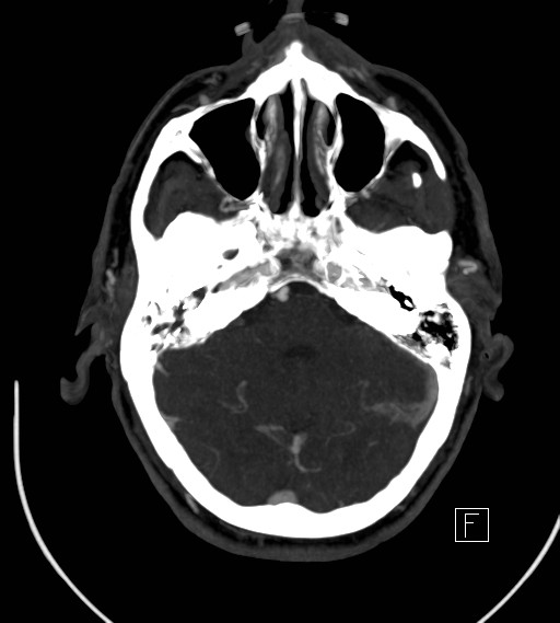 Basilar artery thrombosis (Radiopaedia 26986-27163 A 28).jpg