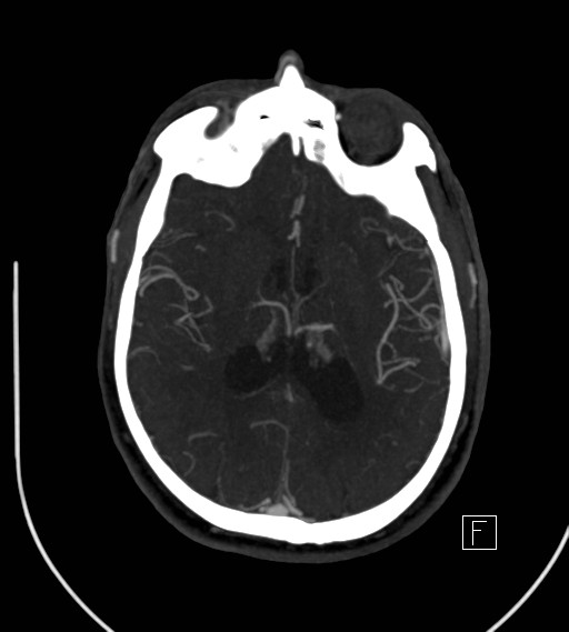 Basilar artery thrombosis (Radiopaedia 26986-27163 A 51).jpg