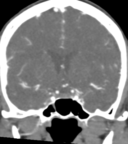 Basilar tip aneurysm with coiling (Radiopaedia 53912-60086 B 60).jpg