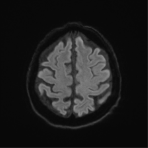 Behavioral variant frontotemporal dementia and late onset schizophrenia (Radiopaedia 52197-58083 Axial DTI Trace W 48).png