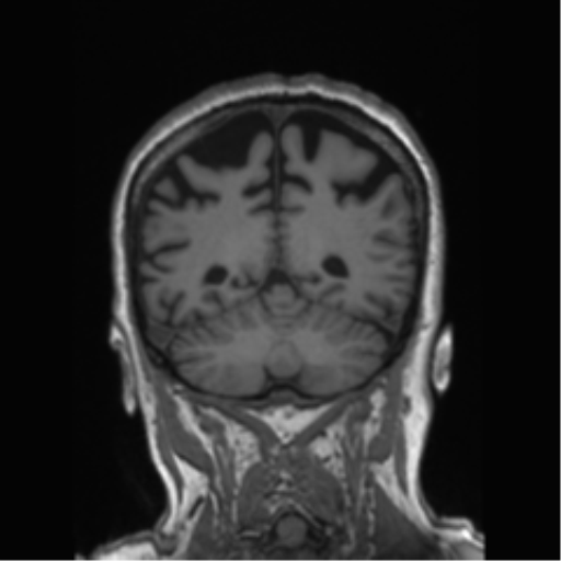 Behavioral variant frontotemporal dementia and late onset schizophrenia (Radiopaedia 52197-58083 Coronal T1 31).png