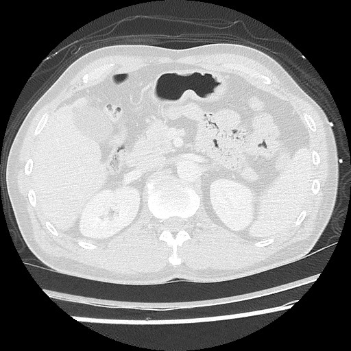 Benign post-traumatic pseudopneumoperitoneum (Radiopaedia 71199-81495 Axial lung window 76).jpg
