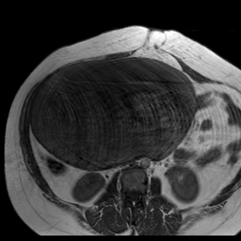 File:Benign seromucinous cystadenoma of the ovary (Radiopaedia 71065-81300 Axial T1 26).jpg