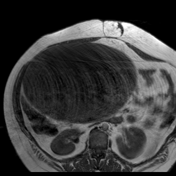 File:Benign seromucinous cystadenoma of the ovary (Radiopaedia 71065-81300 Axial T1 29).jpg