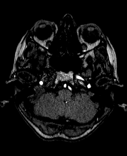 Berry aneurysm of the terminal internal carotid artery (Radiopaedia 88286-104918 Axial TOF 61).jpg