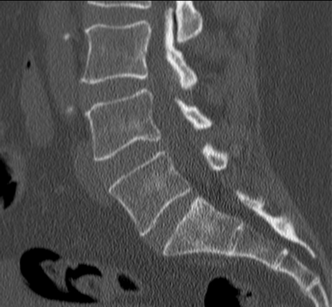 Bertolotti syndrome (Radiopaedia 24864-25128 Sagittal bone window 31).jpg